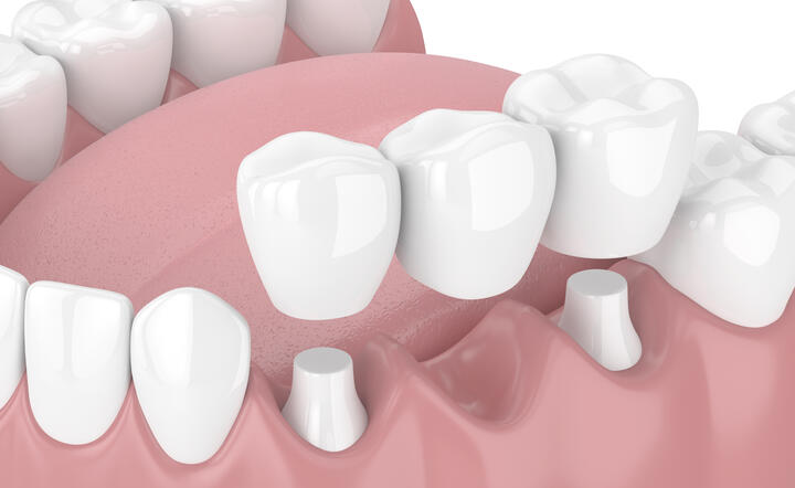 Jak se starat o zubní můstek?